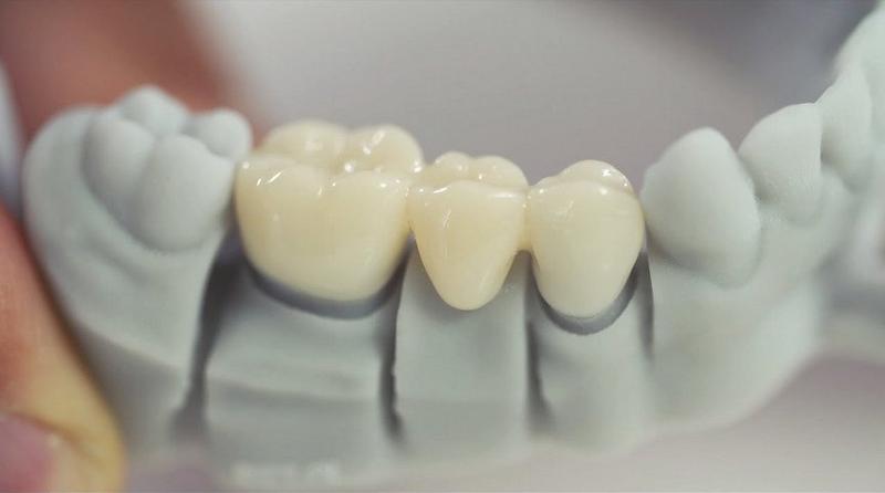 зубы керамика протез